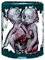 A fetal specimen in a jar